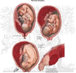 Placental abruption - Version 2.jpg
